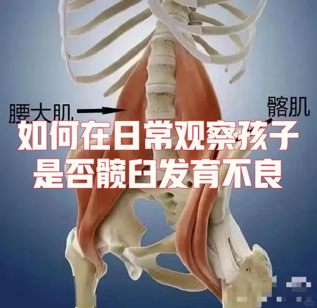 如何在日常观察孩子是否髋臼发育不良