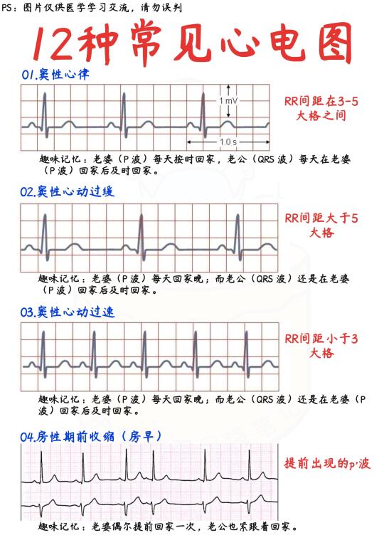 📒医学生笔记｜12种常见心电图合集+速记方法