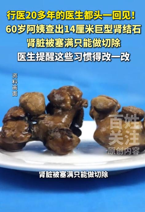 贵州黔南，一位60岁阿姨平时很少喝水，直到两个月前体检才发现，右肾里竟长着一颗近