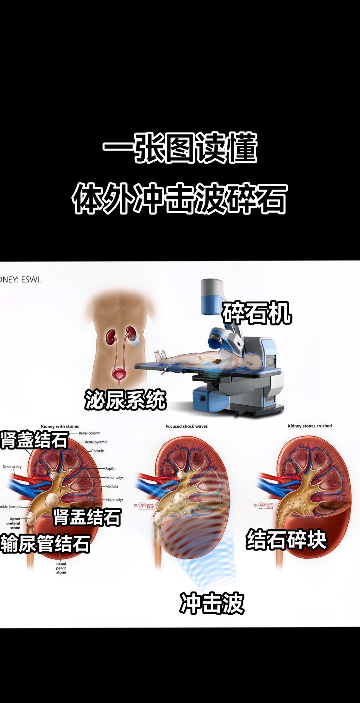 体外冲击波碎石