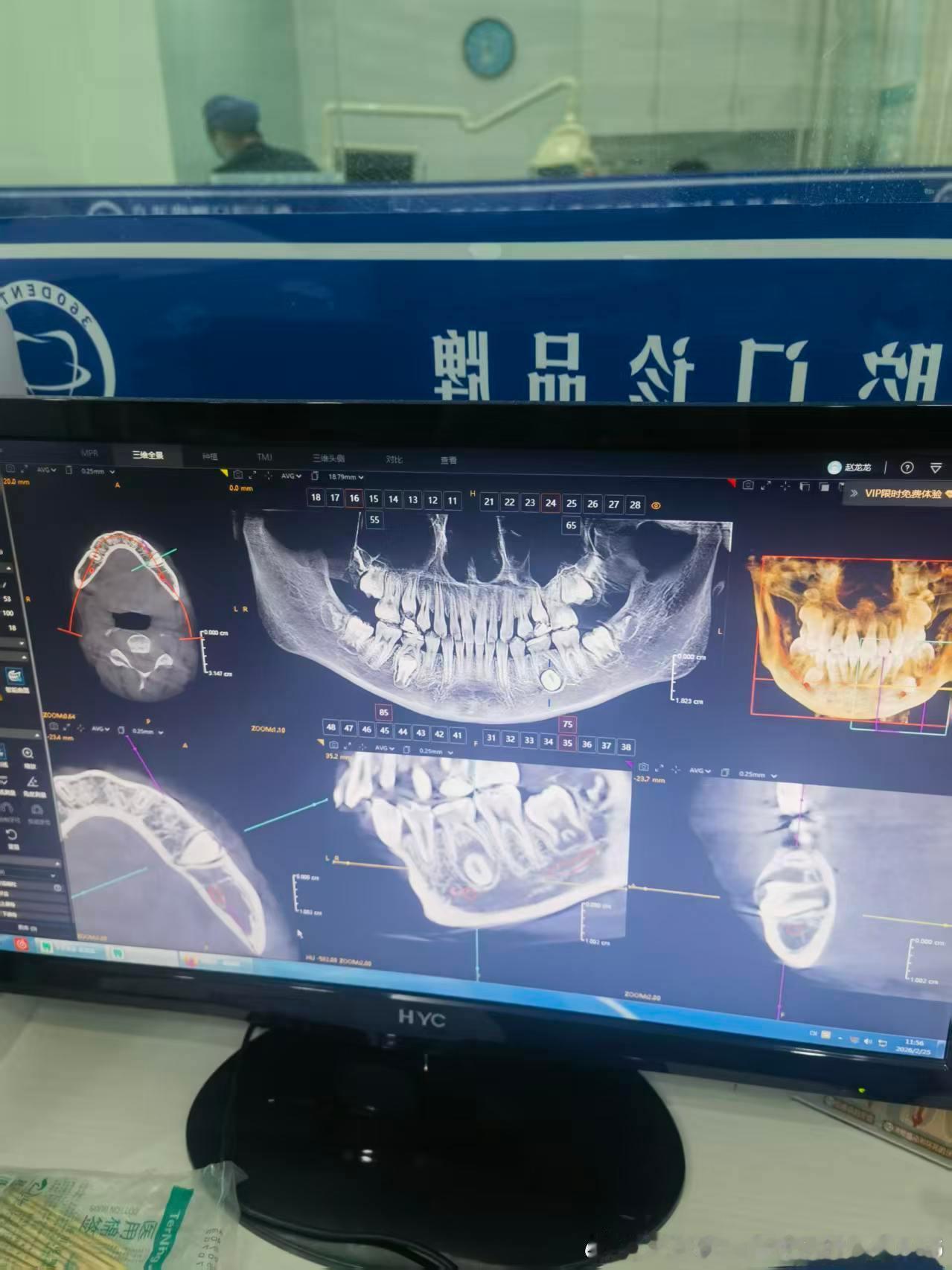 去河南省口腔医院给小北看牙了，横生，医生让在我们诊所先拔了，带几个月保持器，如果