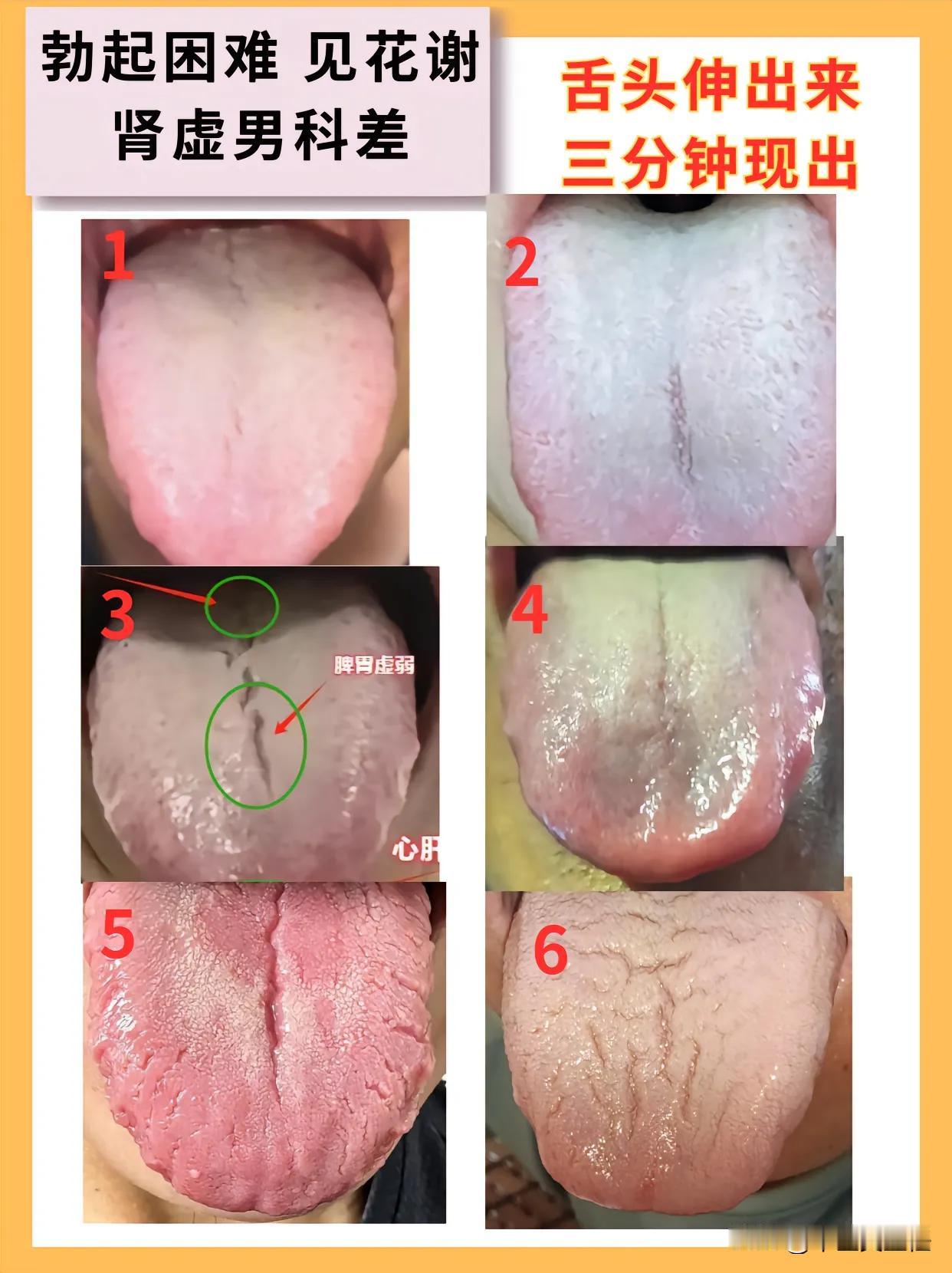 你的肾好不好，中医看看舌头就知道！那你是哪种舌象呢？
今天继续给大家分析舌象，有