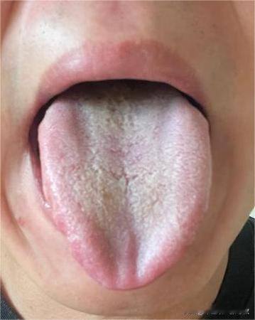 下次可别拖这么久了，你这舌头三岁小孩都能看出来不正常[捂脸][捂脸]

大哥说自