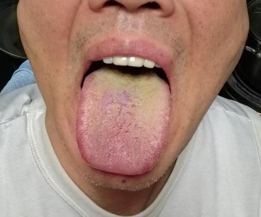 评论区看到的舌象[吐彩虹]，这种湿热舌，房事都很差劲
潘医生教你怎么看，他的男科