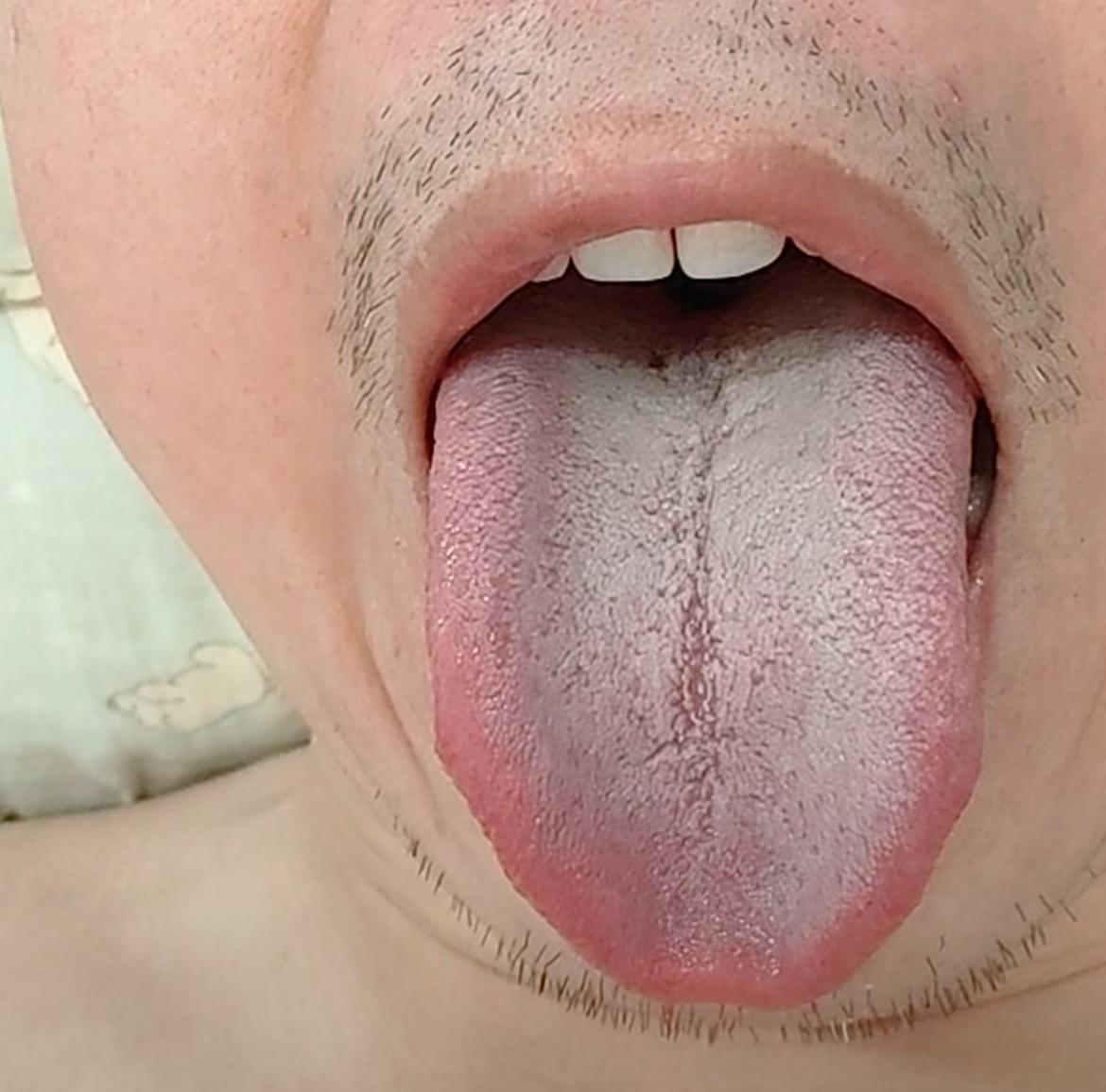 舌中一道裂纹，舌头既红，又白的，你到底遭遇了什么？[捂脸][捂脸][捂脸]
潘医