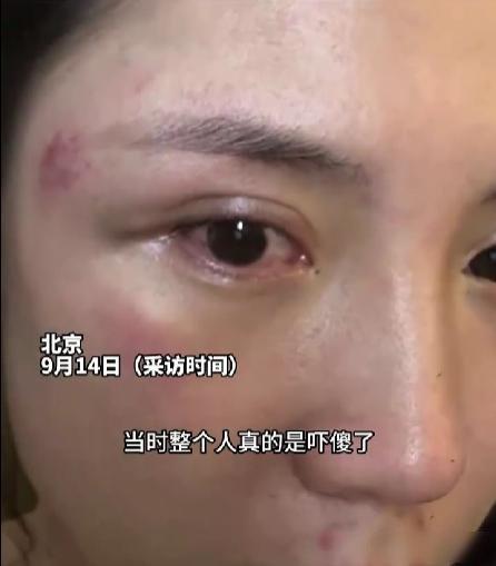 北京突降鸡蛋大冰雹，女子被砸哭站不稳——陌生大哥用站牌、外套护她，伤痕里藏着啥温