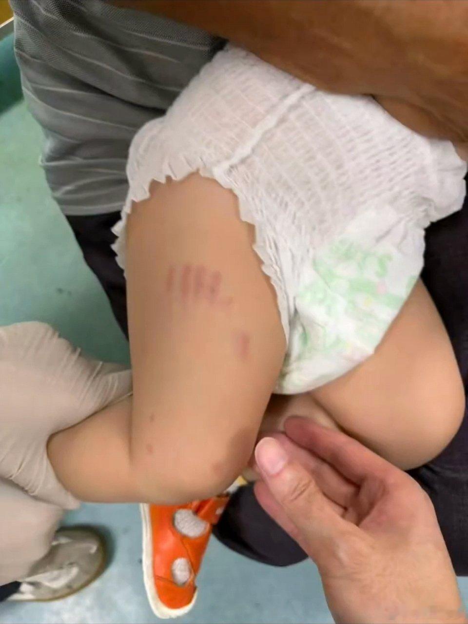 江苏苏州，小区遛狗不拴绳致两名幼童被咬伤。大型犬只不牵绳，处罚力度也很低，即使咬