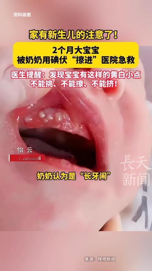 “悲剧还是发生了！”近日，陕西西安，一宝妈给孩子喂奶时，发现宝宝牙龈上有黄白色的