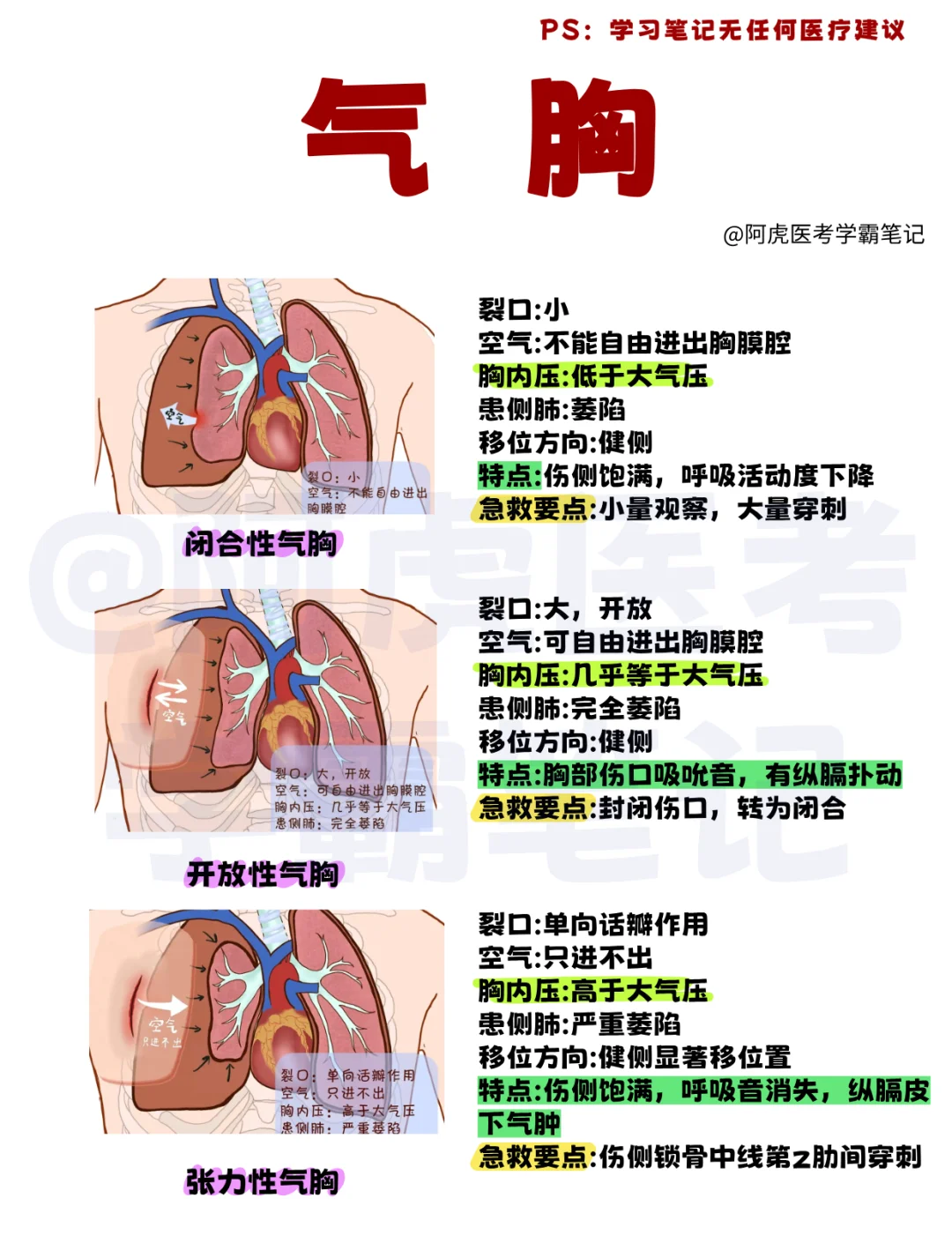 阿虎医考学霸笔记📒：气胸👆