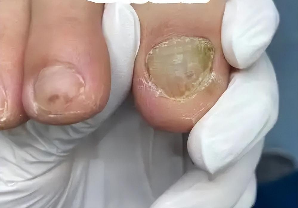 可能存在灰指甲的早期表现，只是你还没注意到。
 
很多人以为灰指甲就是指甲变灰了