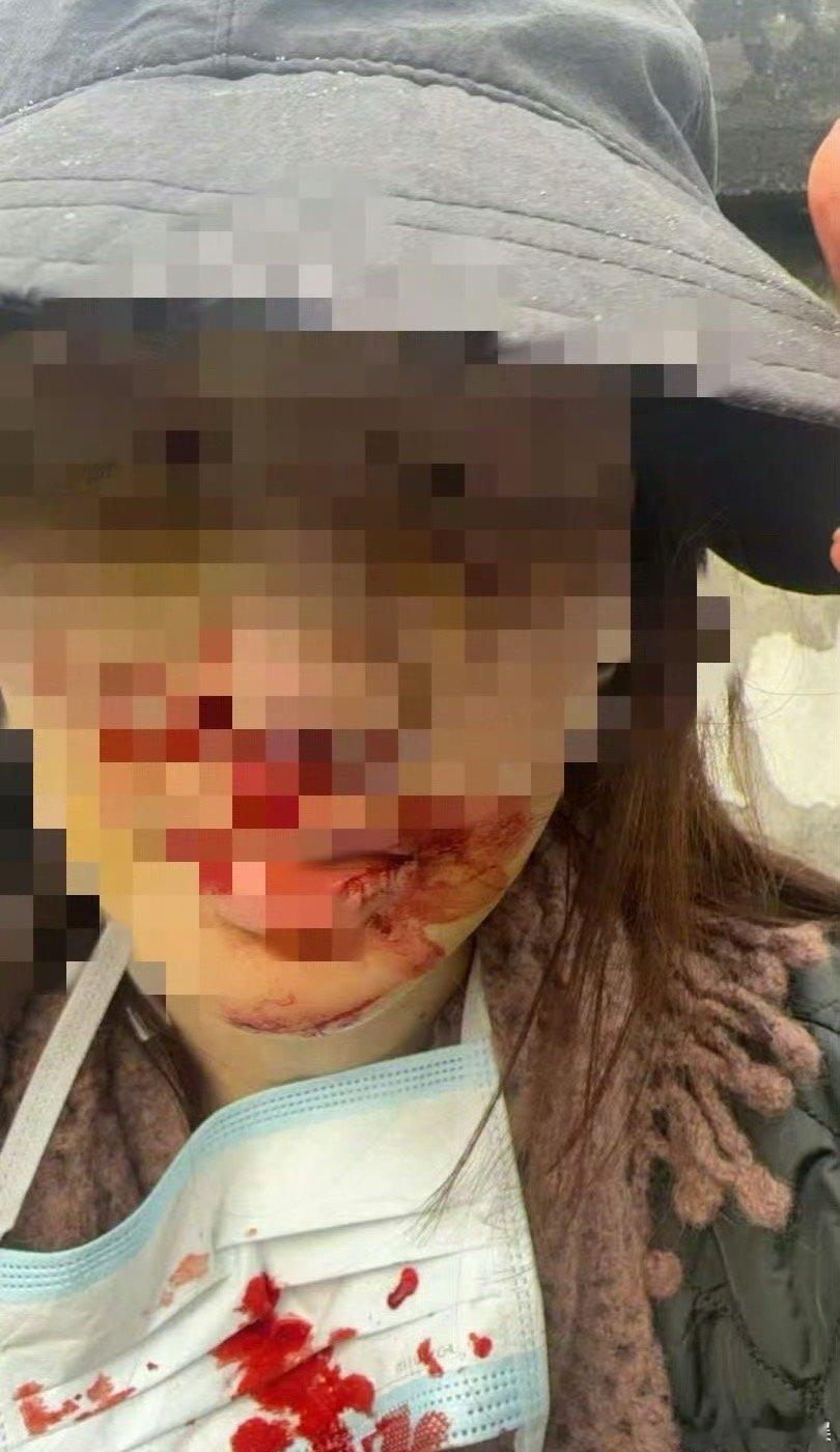 金晨真动脸了天啊！一个女性受的伤！原来都没有说收出来！心疼金晨金晨