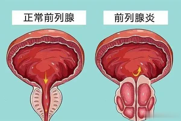 慢性前列腺炎，老王跟你坐下来好好谈谈慢性前列腺炎，被称为“不死的癌症”。很多前列