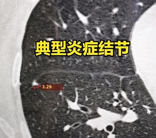 很多朋友发现肺结节，都有一个纠结、不甘：我好好的、很健康，怎么突然就长了肺结节？