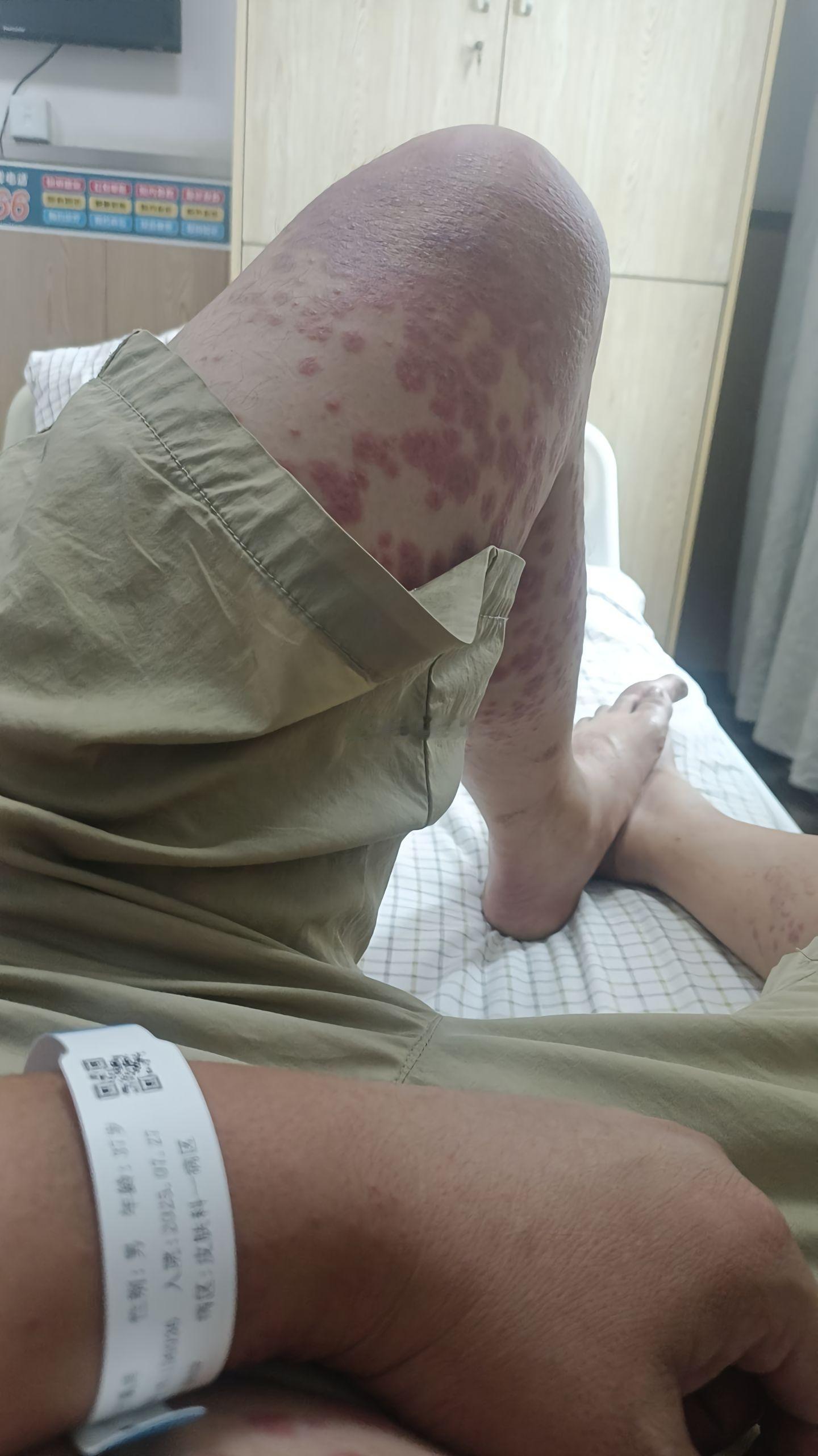 这是什么病？艾滋病还是梅毒？ 