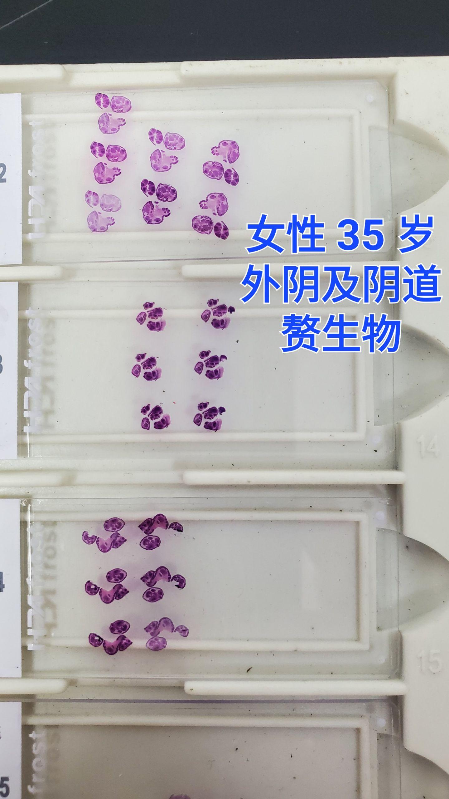 传染性软疣