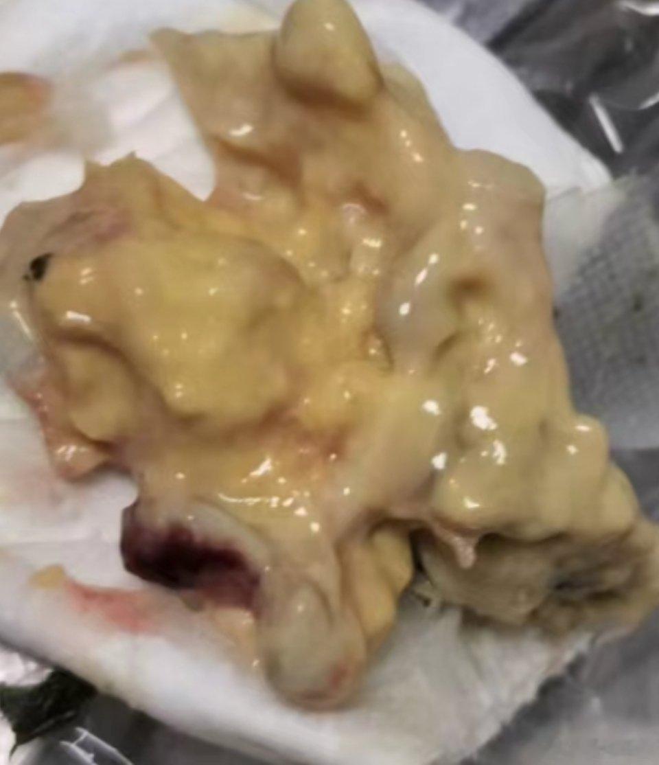 肿瘤里面到底是什么？可能很多医生说不清楚！居临床经验和病人反馈说一下是什么！注要