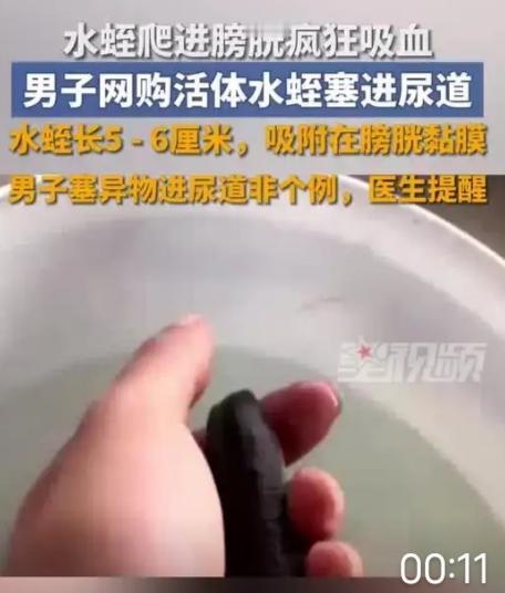 5厘米水蛭塞进尿道！偏方害惨23岁小伙，这些致命谣言该停了
 
23岁的小郑怎么