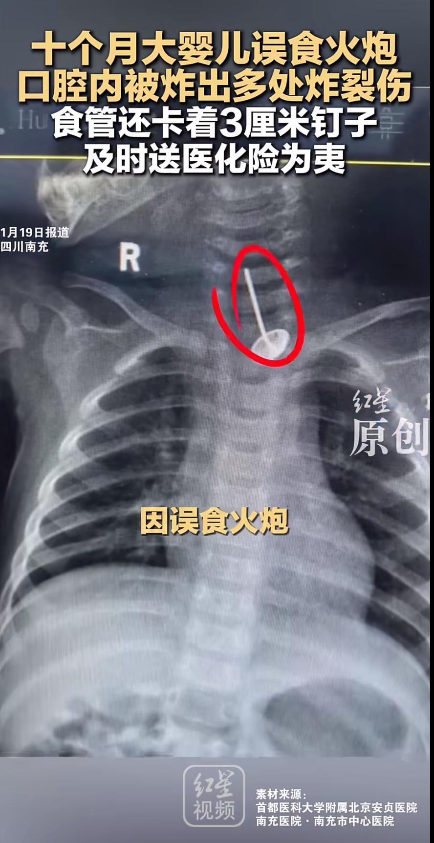 一则揪心的新闻让无数人心惊胆战：四川南充一名仅10个月大的婴儿小溪，因误食一颗摔