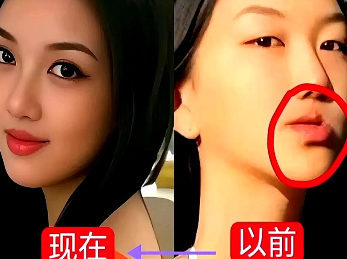 王菲女儿修复手术的太完美了，刷到李嫣的近照差点没敢认！

这完全看不出唇腭裂痕迹