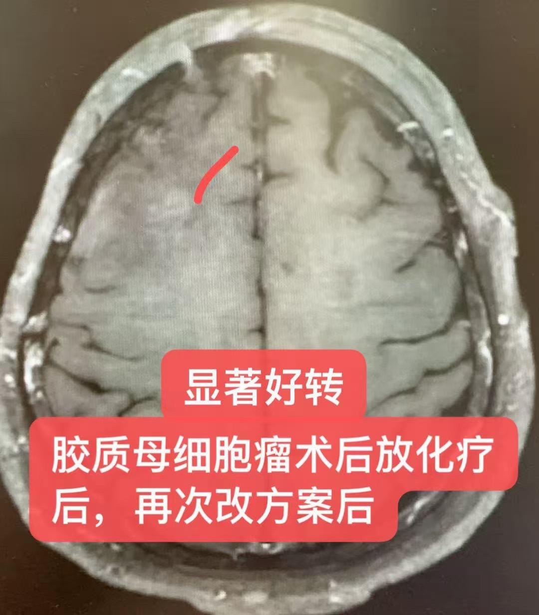 胶质瘤的曲折治疗：个案分享。患者男，51岁，右侧额颞叶胶质母细胞瘤术后...