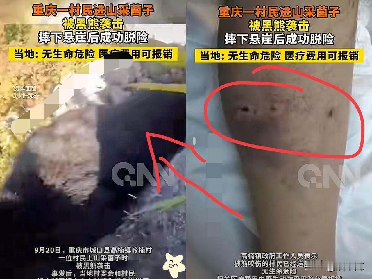 命不是一般的大！重庆，一男子进山摘蘑菇时，竟意外遇到一头黑熊，不仅小腿被咬到，还