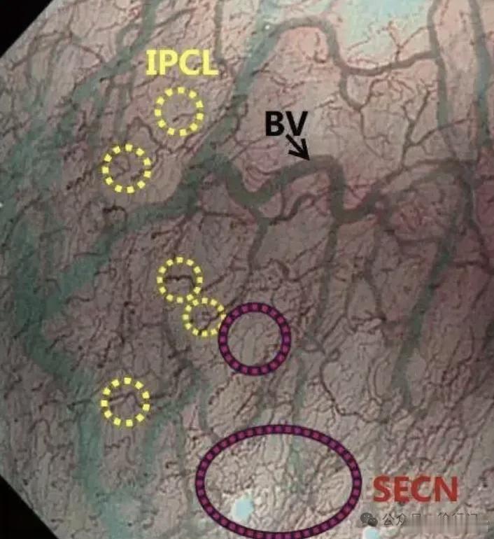 内镜下IPCL（上皮乳头内毛细血管袢）IPCL是食管黏膜上皮乳头内的毛细血管结构
