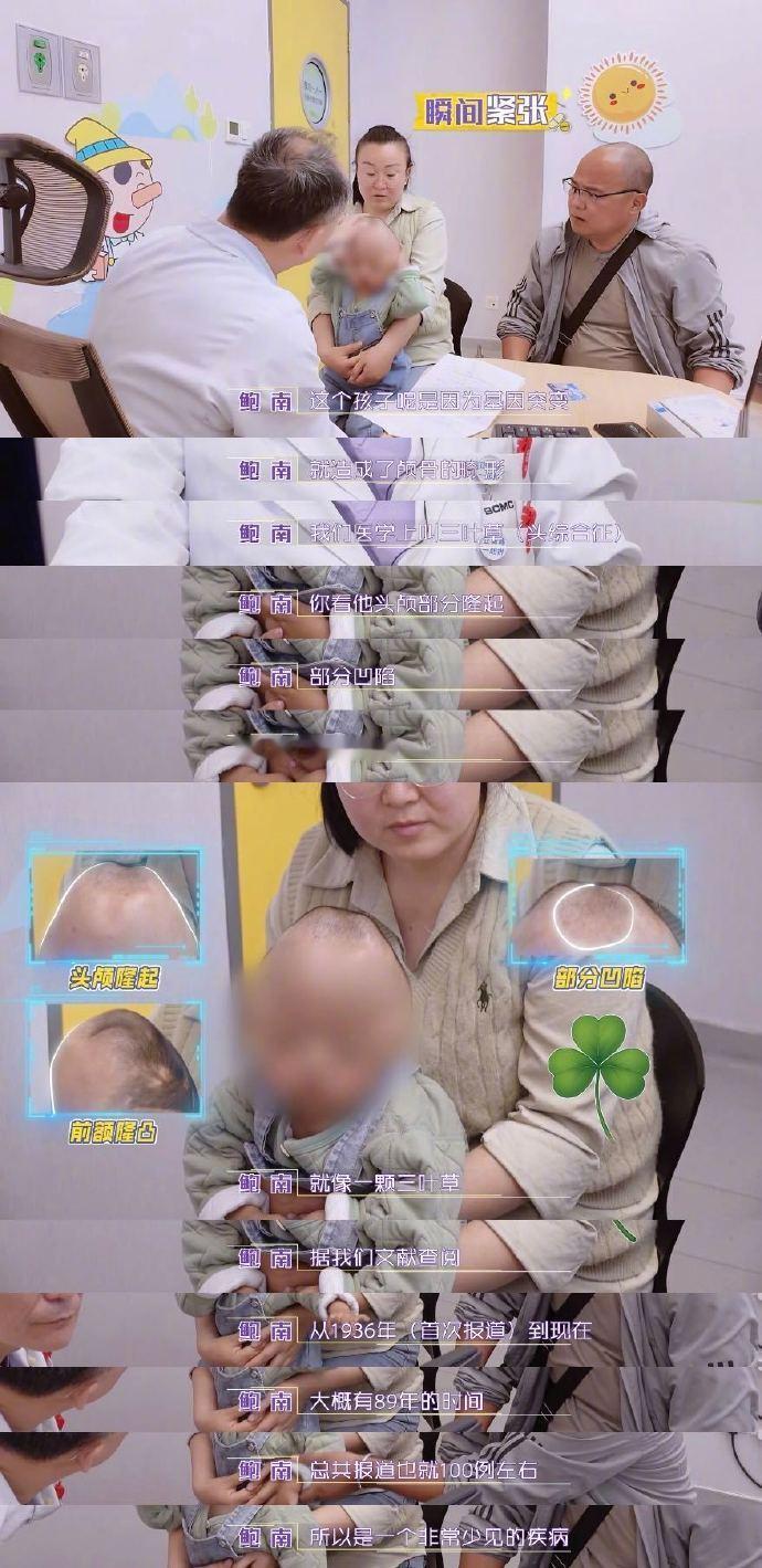 现代医学重塑2岁男孩头骨 《闪闪的儿科医生》里面小贝的颅骨畸形经过医生们的努力直