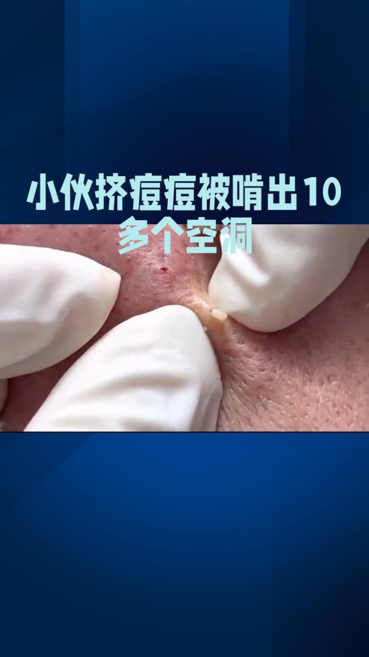 20岁男生挤痘后肺烂10个洞！ICU惊魂12天，这个危险区千万别碰
 
年轻人谁