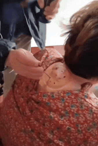 这是真的吗？我认为是假的，一个烧红的锥子扎肉里，人的应激反应肯定有的。话说回来，
