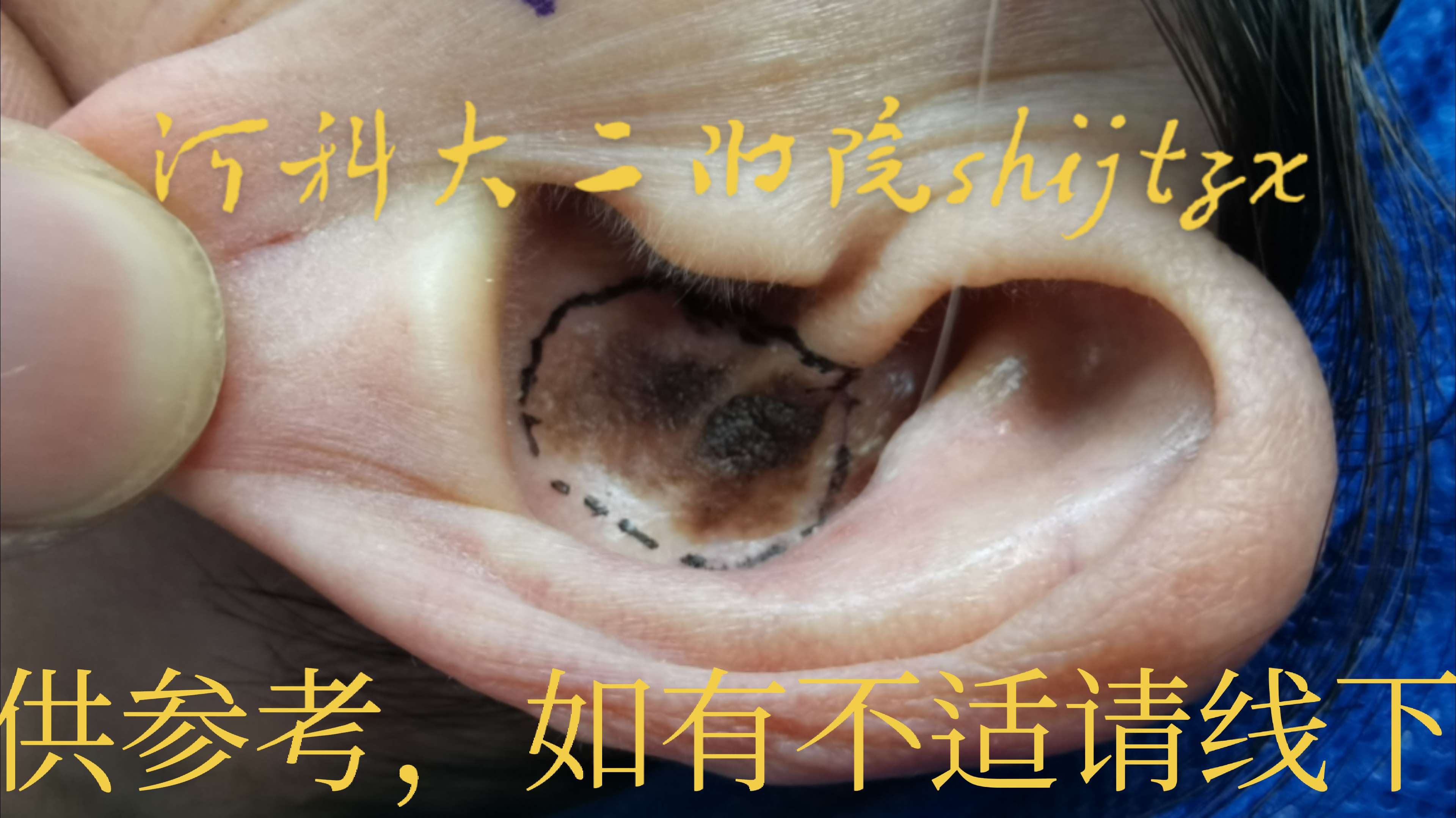 耳廓皮肤肿物。中厚皮片移植术。