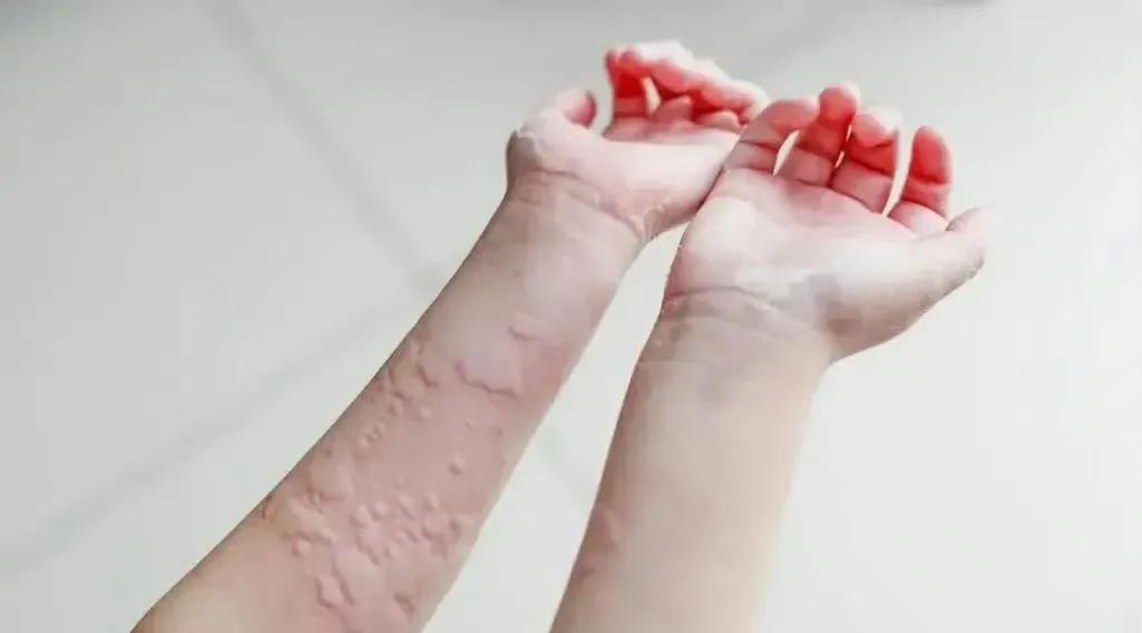 #新手爸妈指南##儿童健康守护者计划# 荨麻疹了是常见病，皮损主要是红斑、风团，