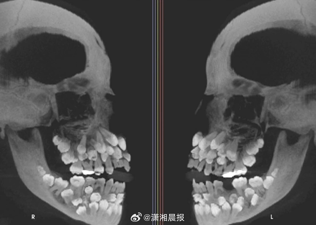 【巴西一#11岁女孩拔牙时发现81颗牙齿#，震惊医生】巴西米纳斯吉拉斯州一名11