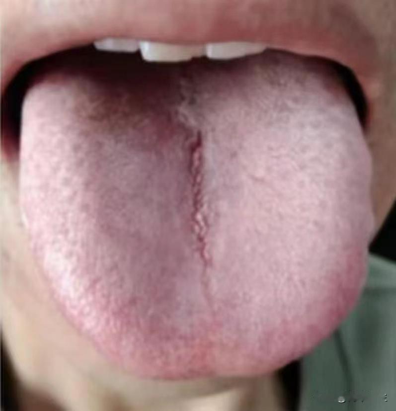 小伙子舌头裂纹都这么深了，单单补肾可不行啊！

有些男同胞一说功能不行，就知道补
