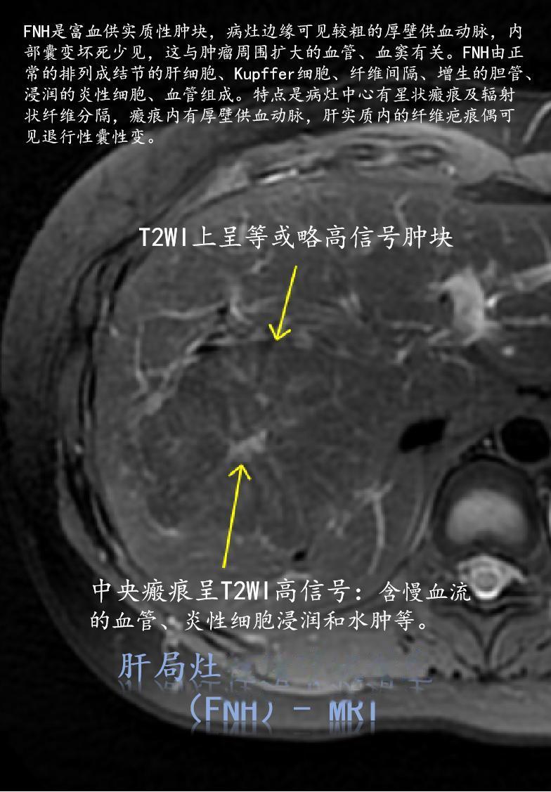 局灶性结节状增生 (focal nodular hyperplasia，FNH)：肝脏良性肿瘤的第二位。
病理变化：FNH是富血供实质性肿块，病灶边缘可见较粗的厚壁供血动脉，内部囊变坏死少见，这与肿瘤周围扩大的血管、血窦有关。FNH由正常的排列成结节的肝细胞、Kupffer细胞、纤维间隔、增生的胆管、浸润的炎性细胞、血管组成。特点是病灶中心有星状瘢痕及辐射状纤维分隔，瘢痕内有厚壁供血动脉，肝实质内的纤维疤痕偶可见退行性囊性变。
典型FNH(80%)三大特点：异常的结节结构、畸形血管、胆管增生。
CT表现：平