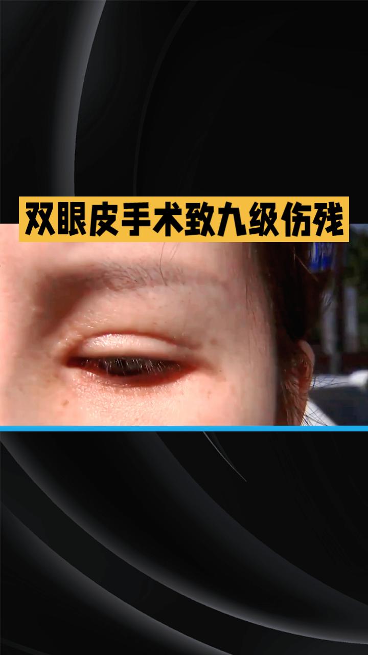 双眼皮手术竟致九级伤残，签下谅解书后为何反被索赔？
苏州女子王丽五年前经老乡介绍