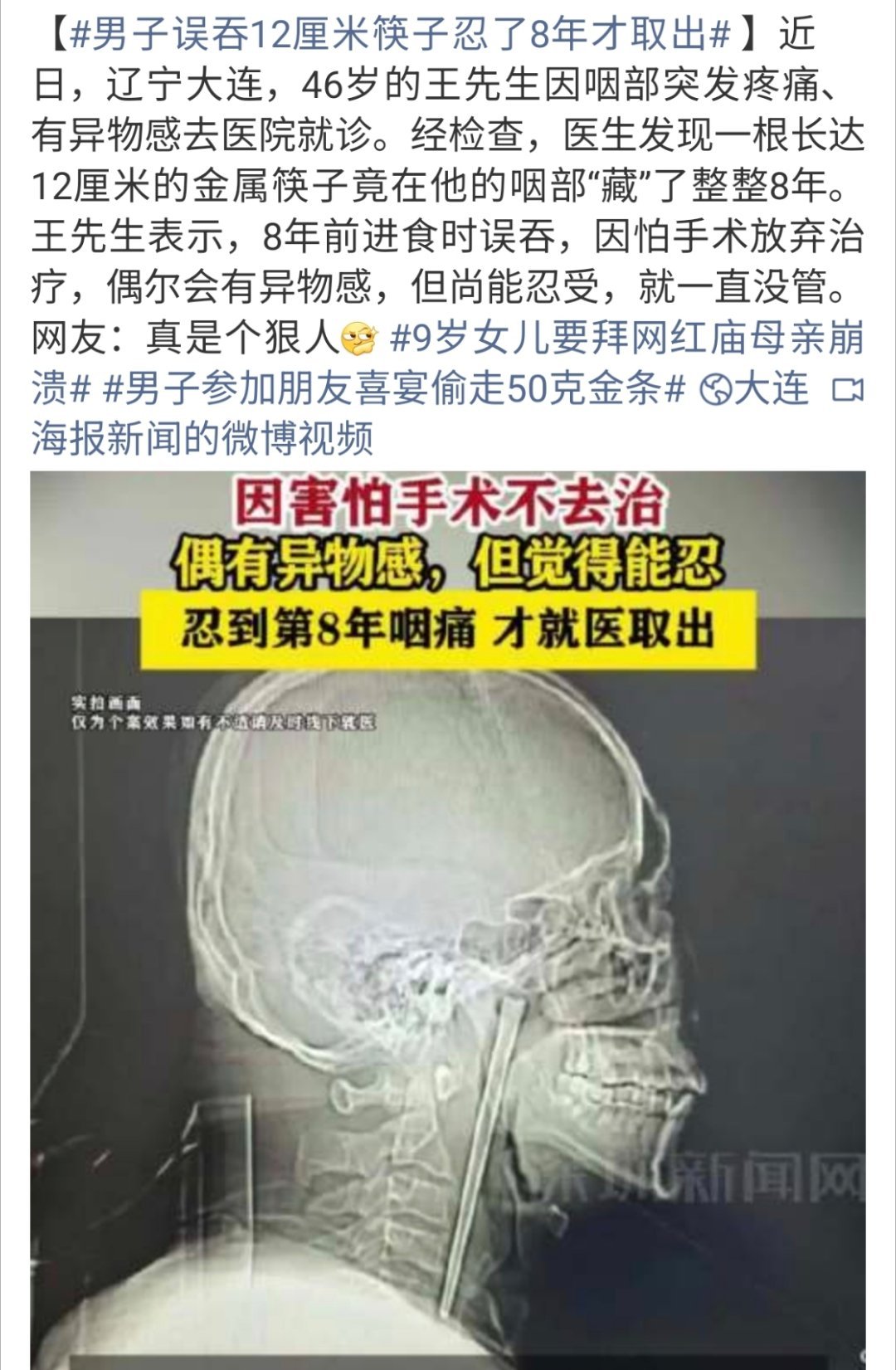 男子误吞12厘米筷子忍了8年才取出最近看到很多这种神人是怎么让这些东西进的身体还
