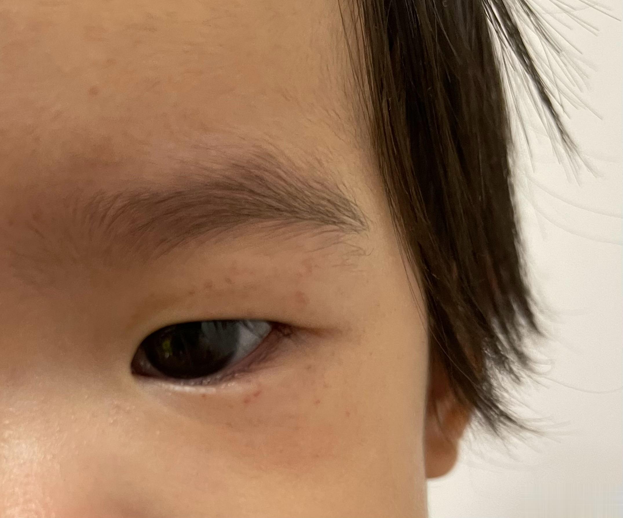 可可昨晚哭了一场眼睛旁边出现一圈这个……叫什么，皮疹？皮下出血点？今天退下去点。