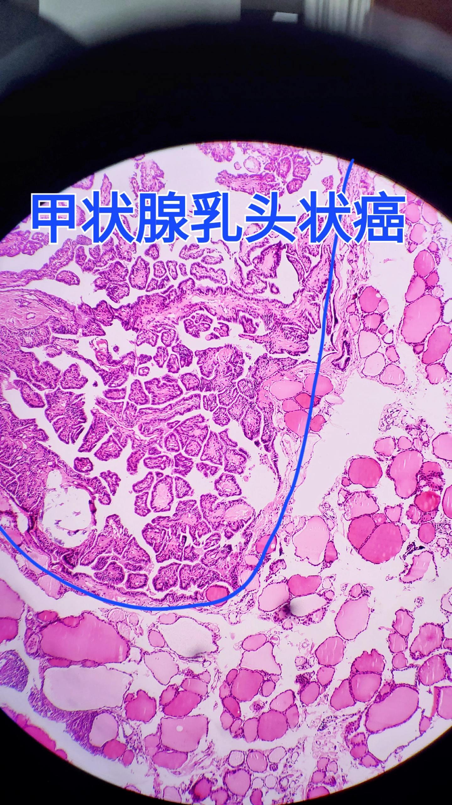 甲状腺乳头状癌