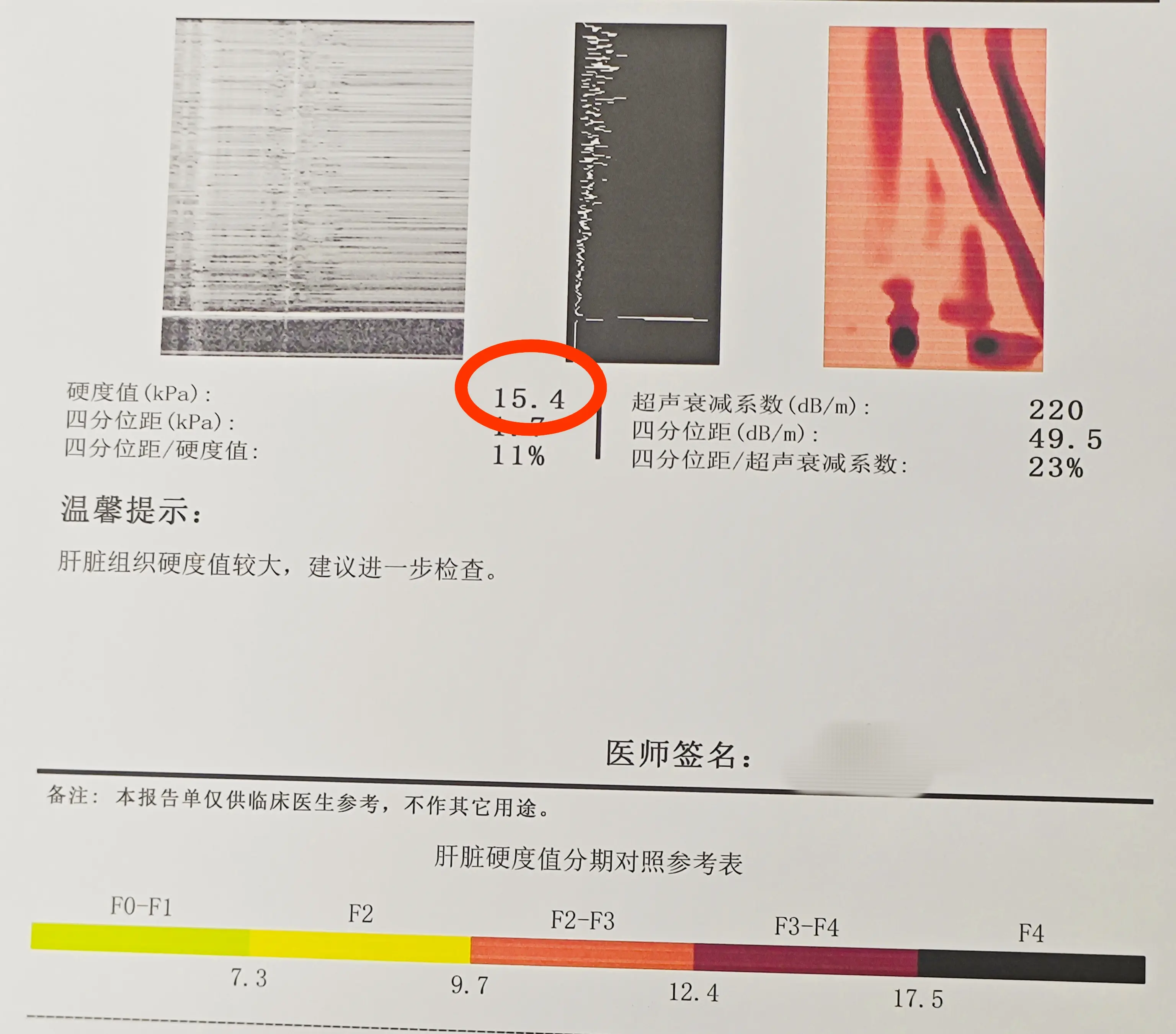 肝硬化。其实这个小伙子身上的小红点就是蜘蛛痣，形状类似蜘蛛因而得名，形...