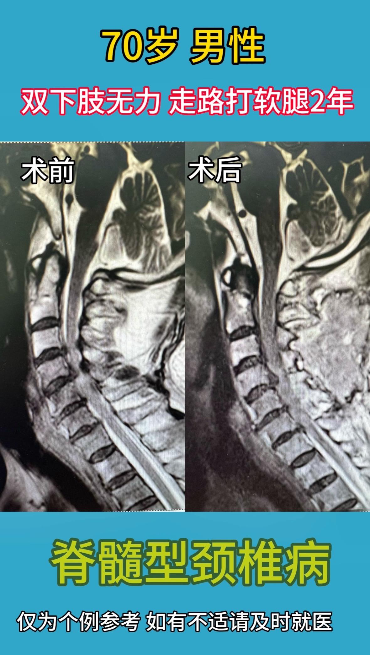 70岁男性，双下肢无力，走路打软腿2年。1周前干农活时突然双下肢瘫痪...