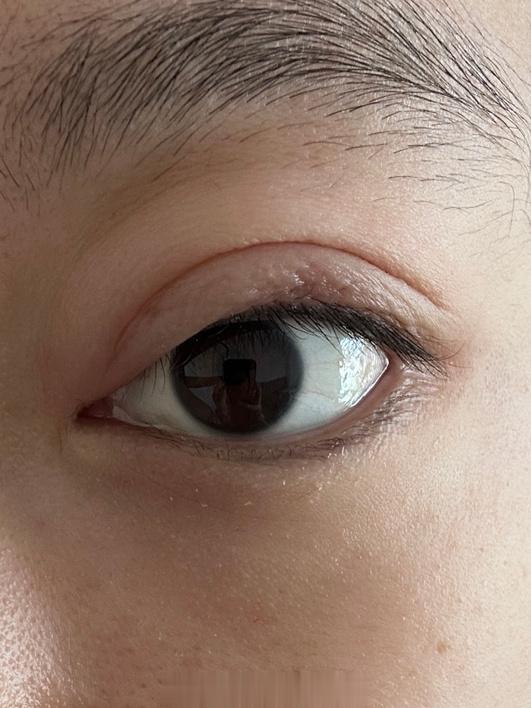 救命我眼睛超级无敌肿什么情况怎么办[报税][报税][报税][报税][报税][报税