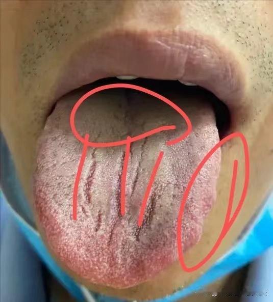 这种裂纹舌，别误治，小心伤了身体，裂纹还在！
看这个舌头中间布满了川字纹的裂纹，