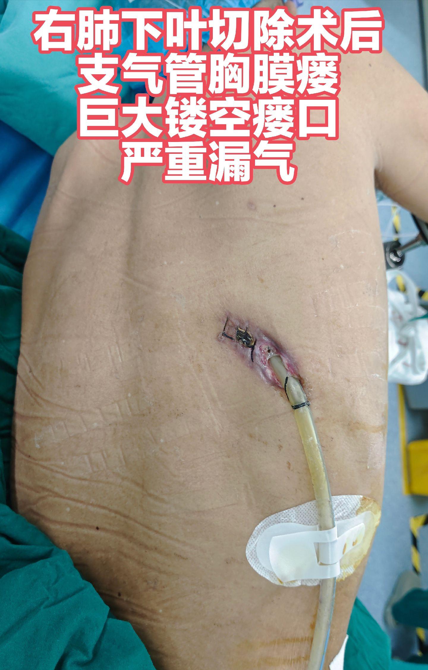 长春病友，右肺下叶切除术后，支气管胸膜瘘，巨大瘘口，严重漏气。辗转找到...