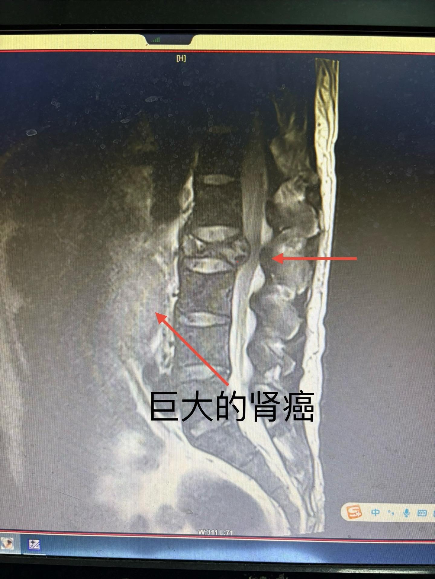 肾癌晚期骨转移，行骨水泥＋粒子植入，我们能做的就是减轻病人痛苦改善生活...