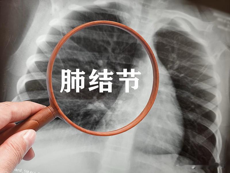现在的年轻人都长肺结节，而且肺结节恶变也开始年轻化，这个现象很可怕。很多人怀疑是
