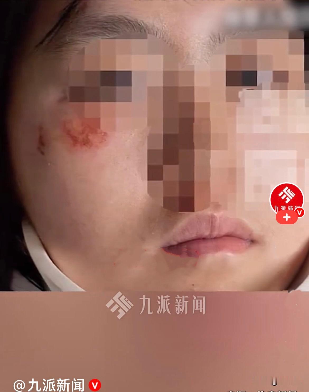 太气愤……
光天化日之下，竟然有人敢当街对未成年人下死手……
       近日