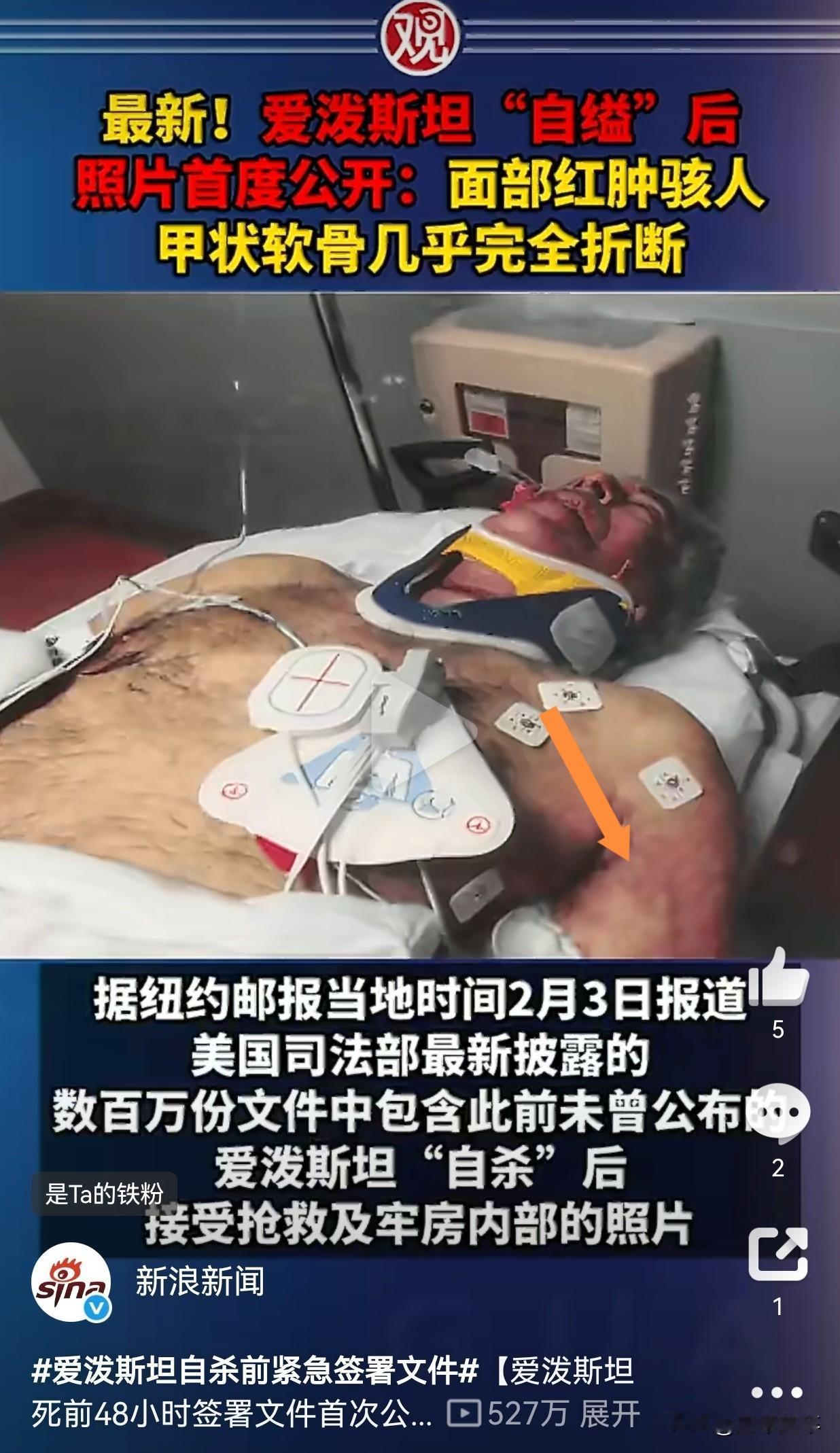 爱泼斯坦死亡成密了？
今天有媒体公布了爱泼斯坦在狱中抢救的视频，却让人发现了一个