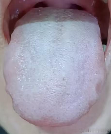 舌苔白腻，毫无血色，用真武汤温阳去湿无效，怎么回事？

这是一位粉丝朋友发来的舌