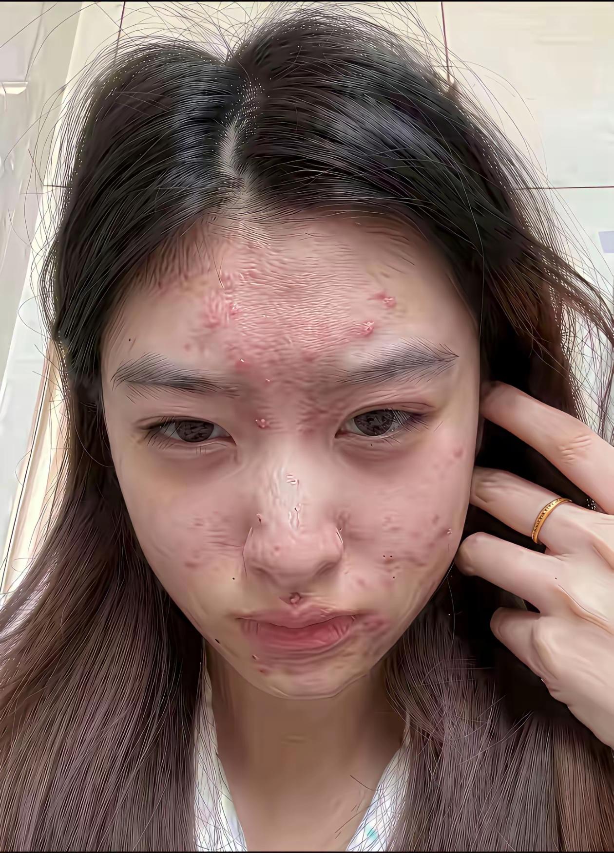 脸上有那么多痘痘，该如何调理呢？