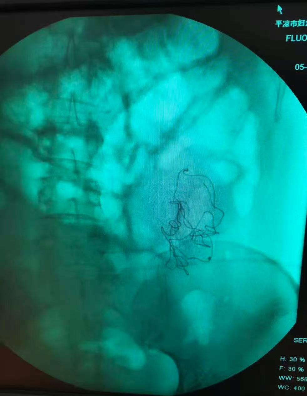 甘肃平凉的秦红利一家，四年多来的生活被一场可怕的医疗失误彻底碾碎了，原本她更倾向